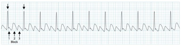 Atrial Flutter • LITFL • ECG Library Diagnosis