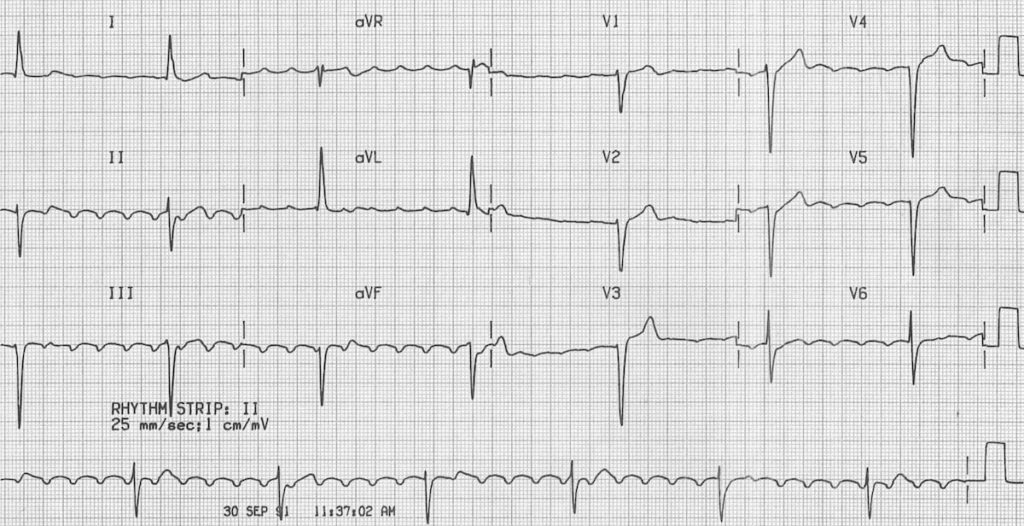 Atrial flutter with block digoxin toxicity