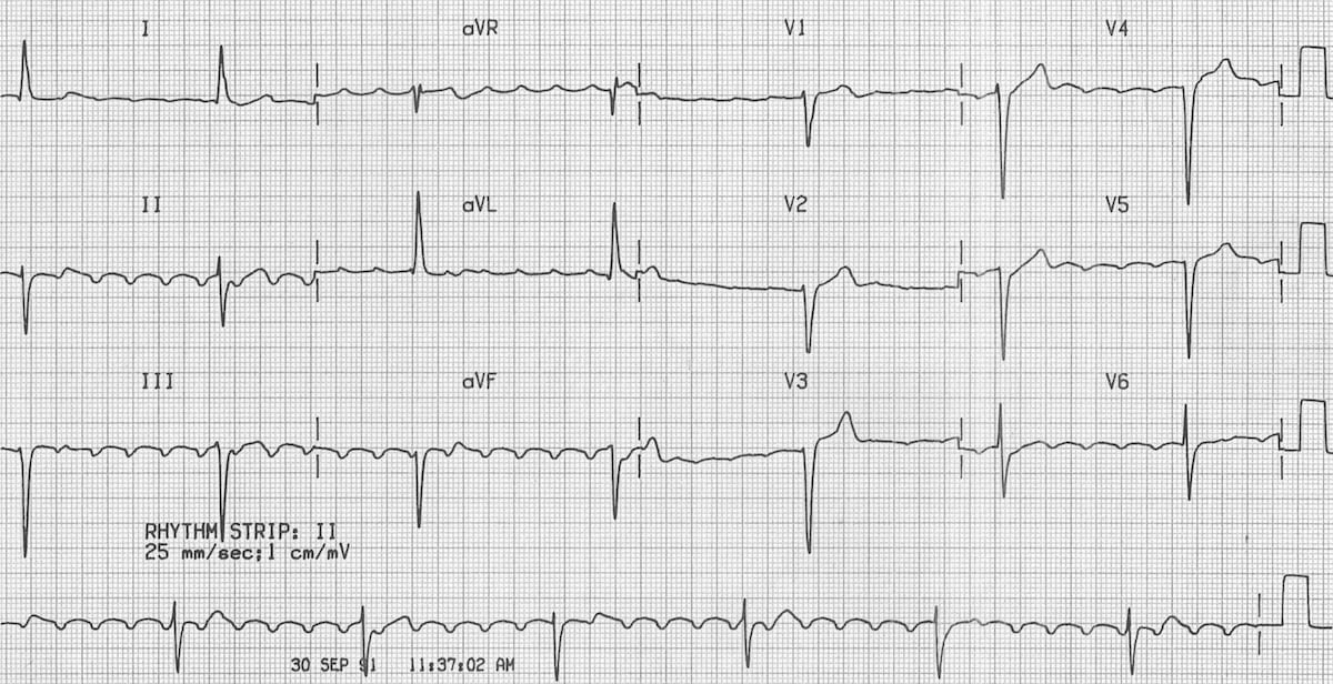 digitalis ecg