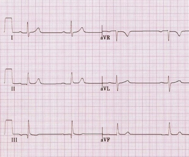 ECG Axis Interpretation LITFL ECG Library Basics