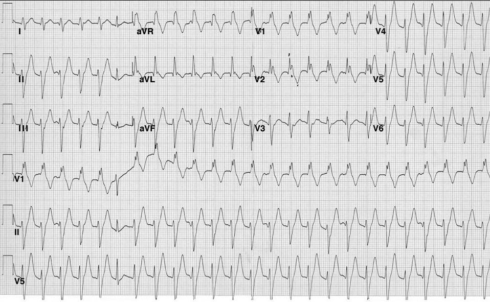 Idiopathic Fascicular Left Ventricular Tachycardia Litfl Ecg Library