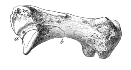 Bennet-fracture 1882 woodcut
