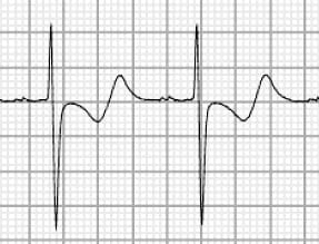 The T-Wave Explained - What Do T Waves On An ECG Represent?