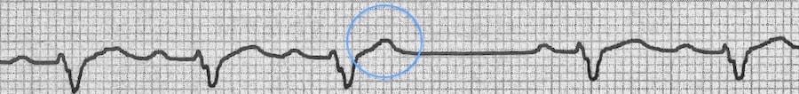 blocked premature atrial contractions