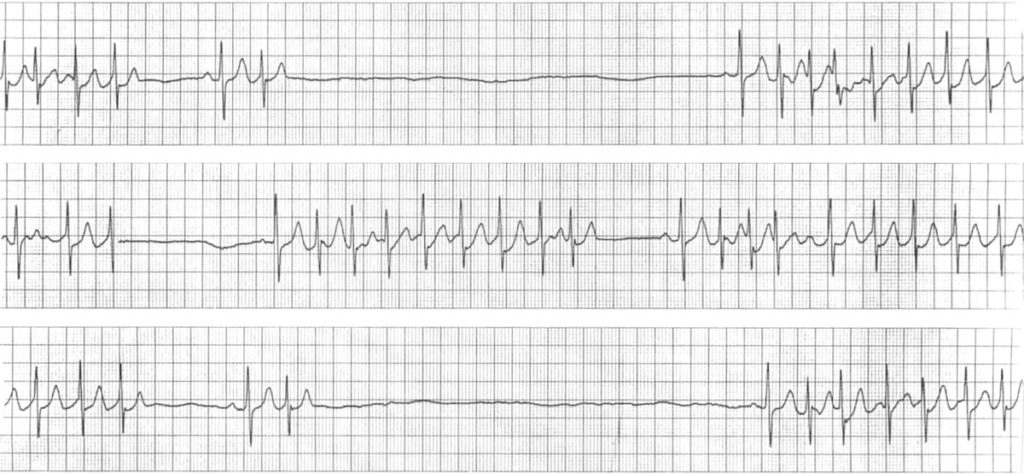 Ecg Litfl Sinus Library Diagnosis Ventricular Tachycardia Ekg Rhythm ...