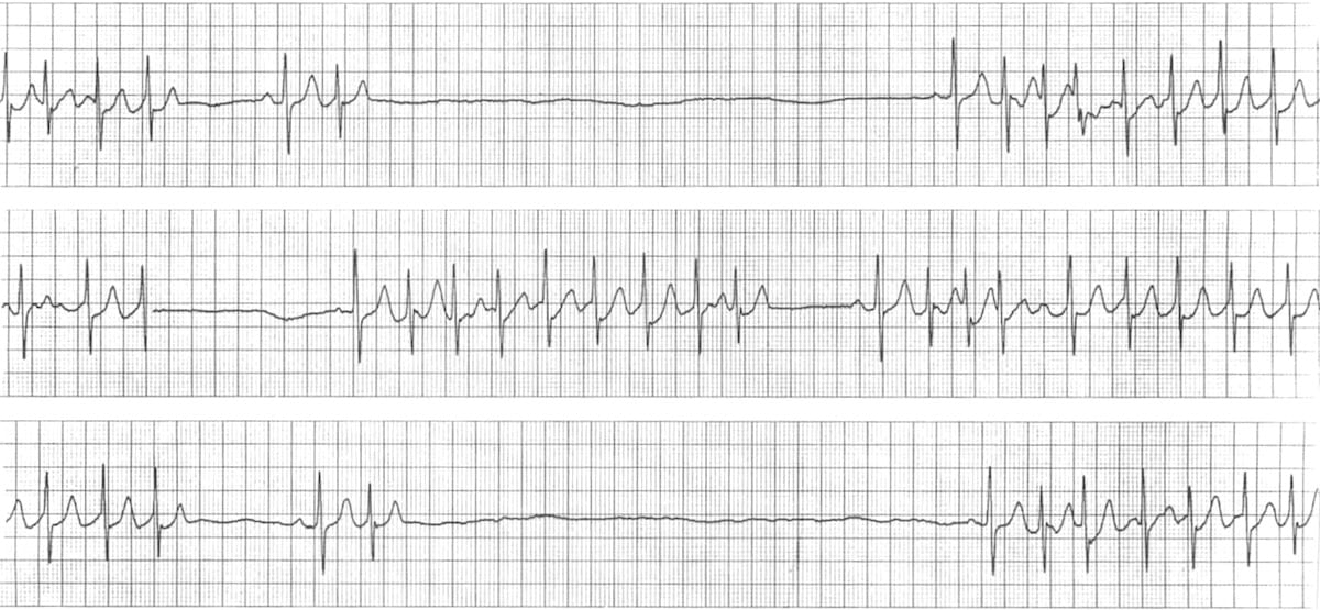 ECG Essentials - Sinus Rhythms & Arrhythmias