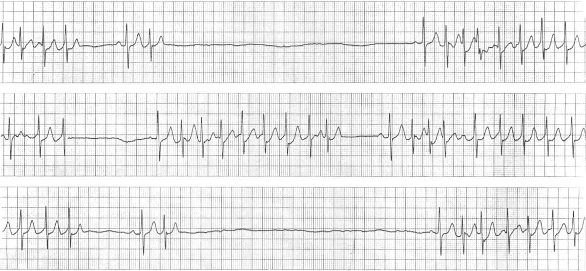 Sinus Node Dysfunction Sick Sinus Syndrome LITFL ECG Library
