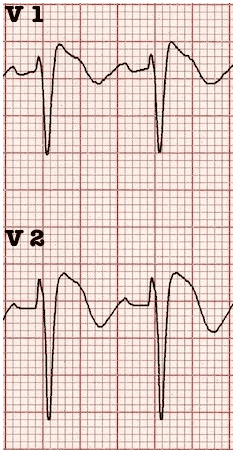 Ventricular Tachycardia and Bradycardia Jeopardy Template