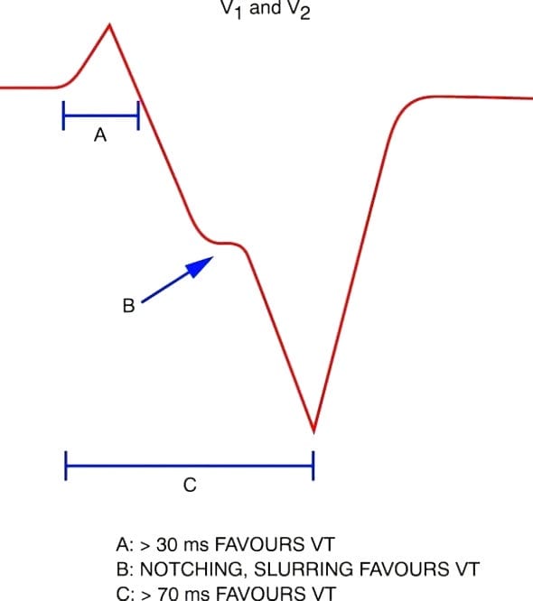 Brugada-criteria-LBBB-VT-V1-2 Wellens