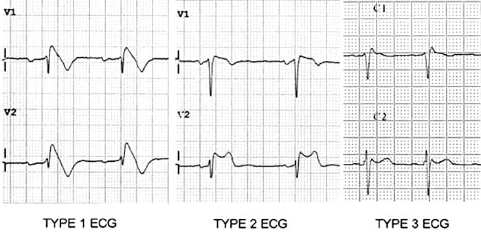 Brugada Syndrome Litfl Ecg Library Diagnosis