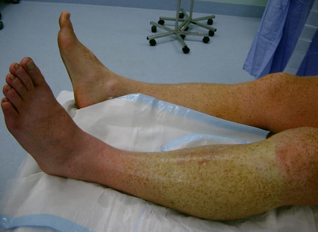 Muscular Claustrophobia LITFL Bone And Joint Clinical Cases