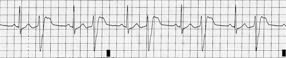 digitalis ecg