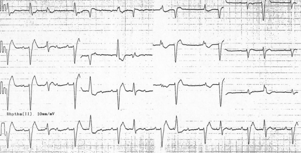 Digoxin Toxicity atrial tachycardia with block and frequent PVC