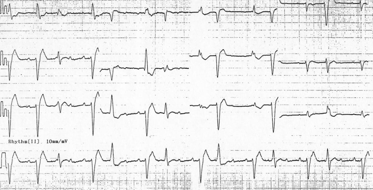 digitalis ecg