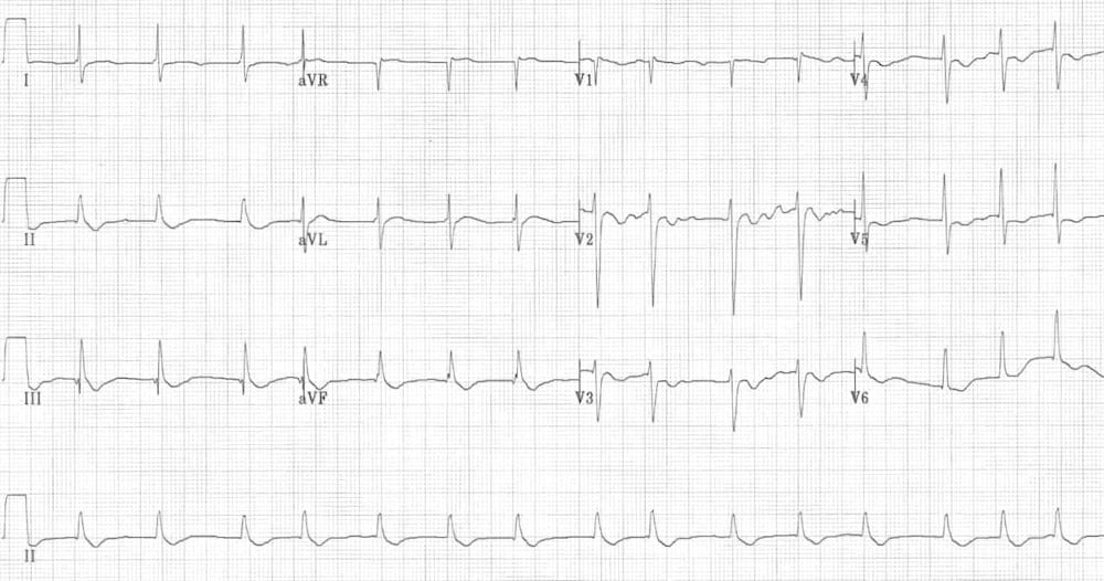 digitalis ecg