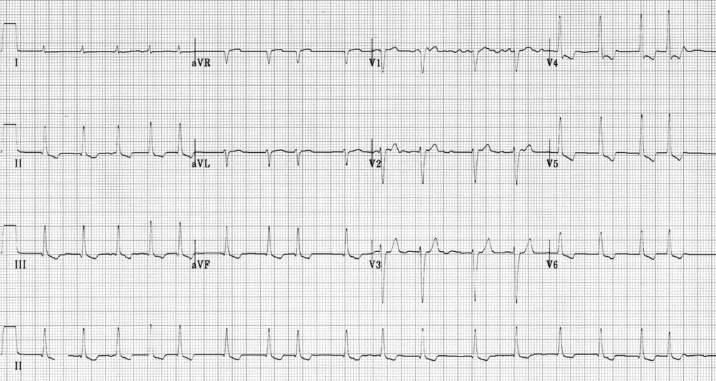 digitalis ecg