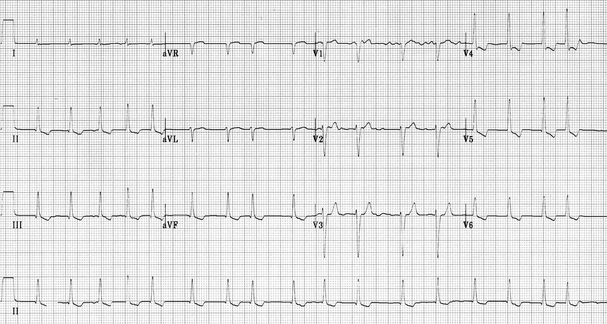 digitalis ecg