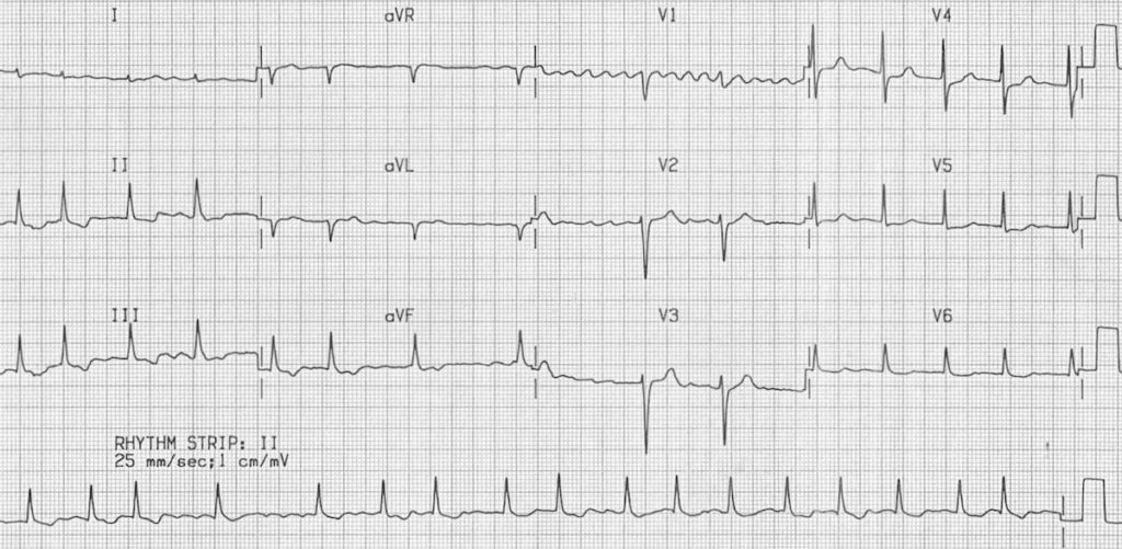 Digoxin effect AF fibrillatory waves V1 2