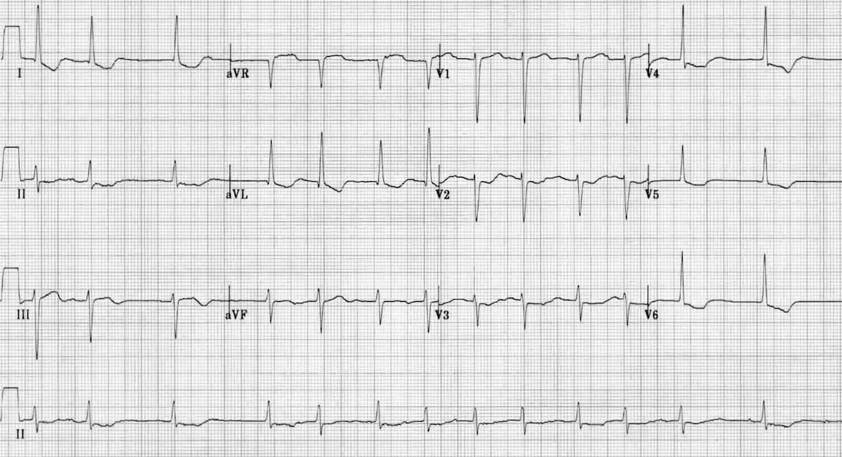 digitalis ecg