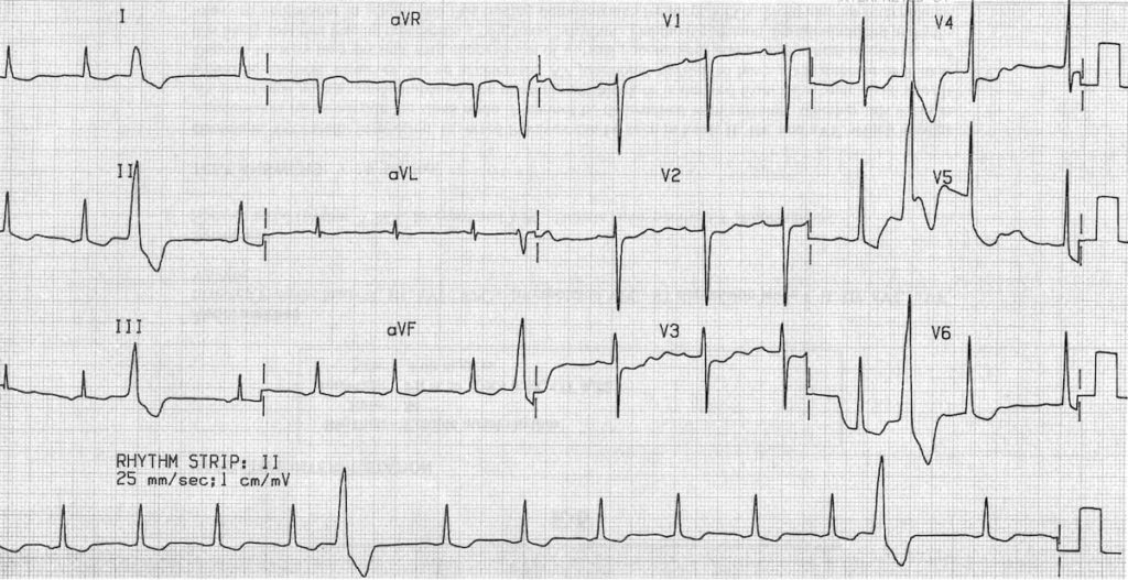 Digoxin effect and Digoxin toxicity