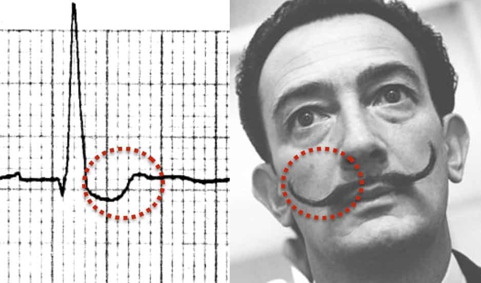 digitalis ecg