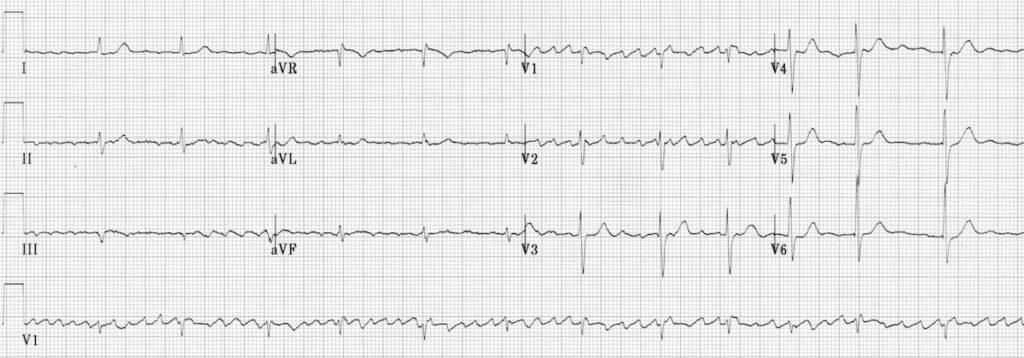 Digoxin toxicity Regularised atrial fibrillation AF