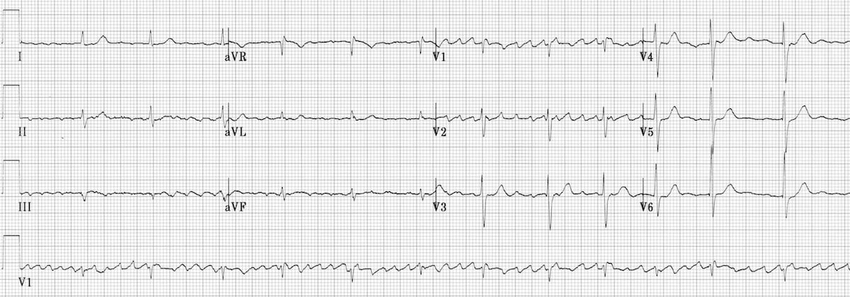 Junctional Escape Rhythm • • Library Diagnosis