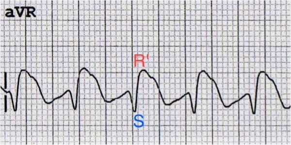 Tricyclic Overdose • LITFL • ECG Library