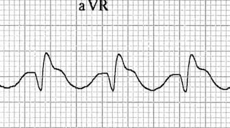 Dominant secondary R' wave in aVR TCA Toxicity