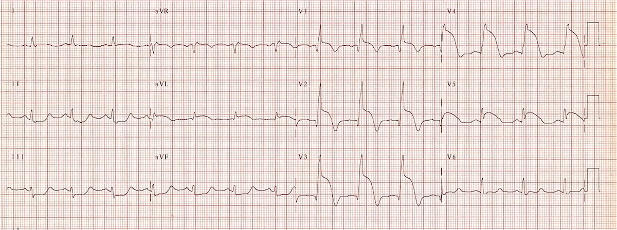 Myocardial Infarction Ecg Interpretation