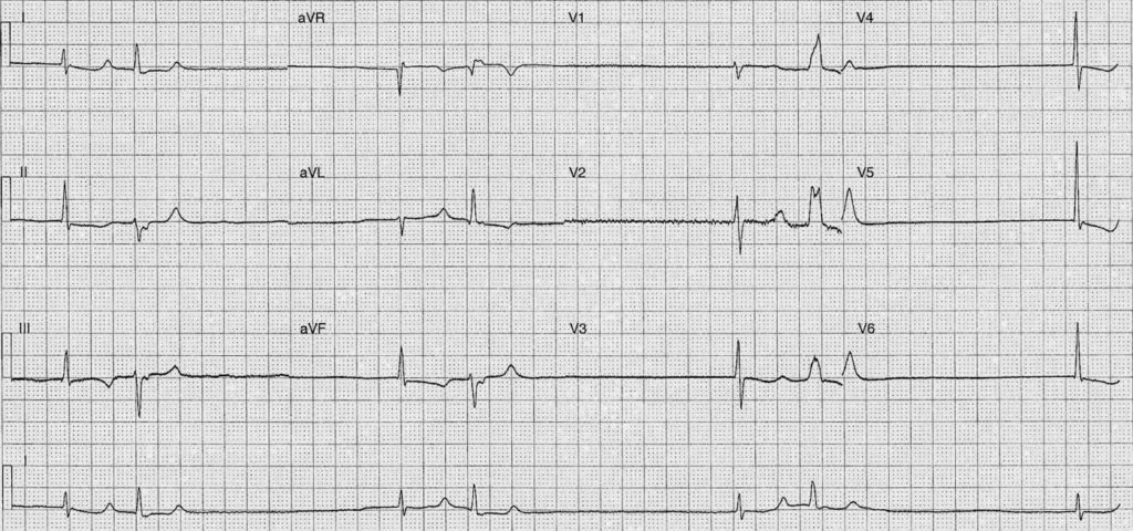 ECG Case 077 • LITFL • ECG Top 100 Self-Assessment Quiz