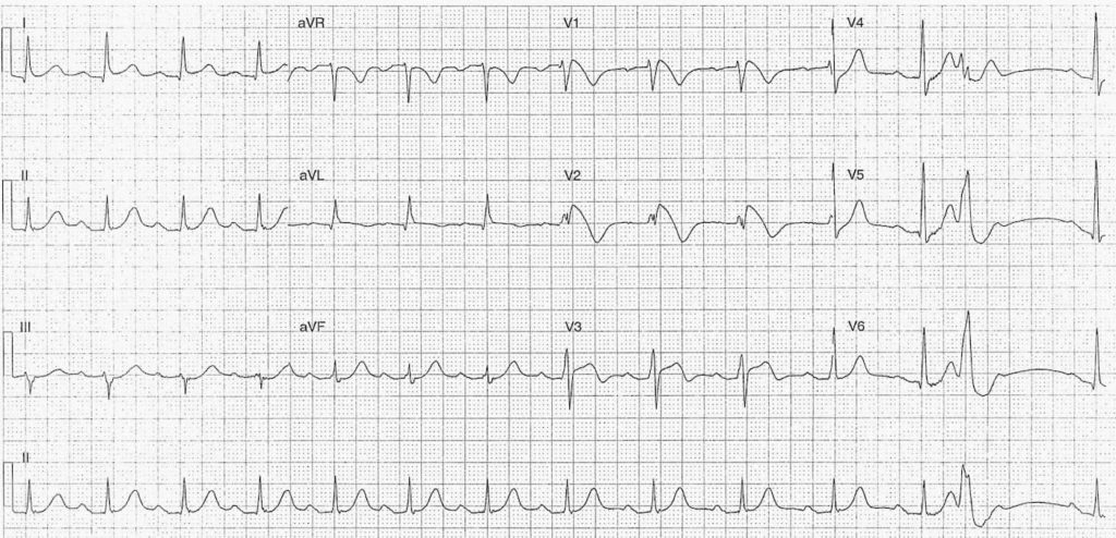 ECG 080 LITFL Top 100 EKG