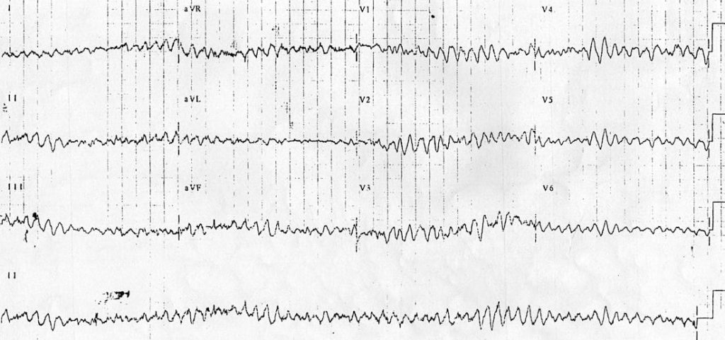 ECG 12 lead VF ventricular fibrillation