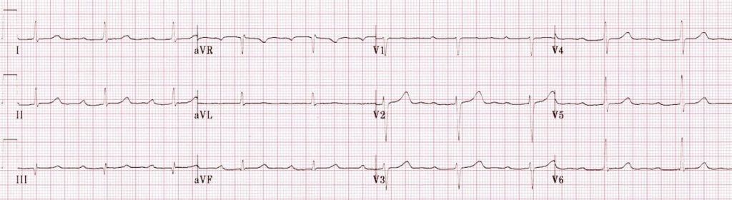 ECG 1st degree AV block 1