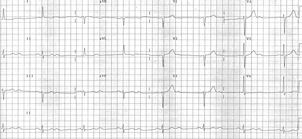 ECG 2 to 1 AV Block P mitrale