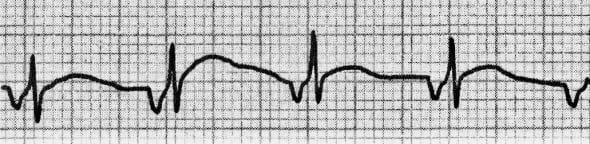 junctional bradycardia rhythm strip