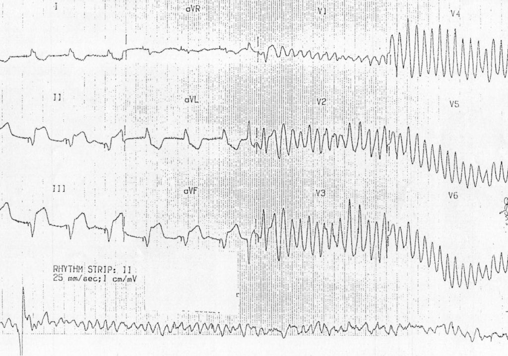 ECG AMI STEMI to VF