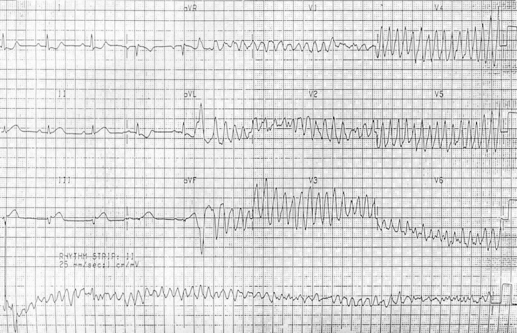 ECG AMI STEMI to VF 2