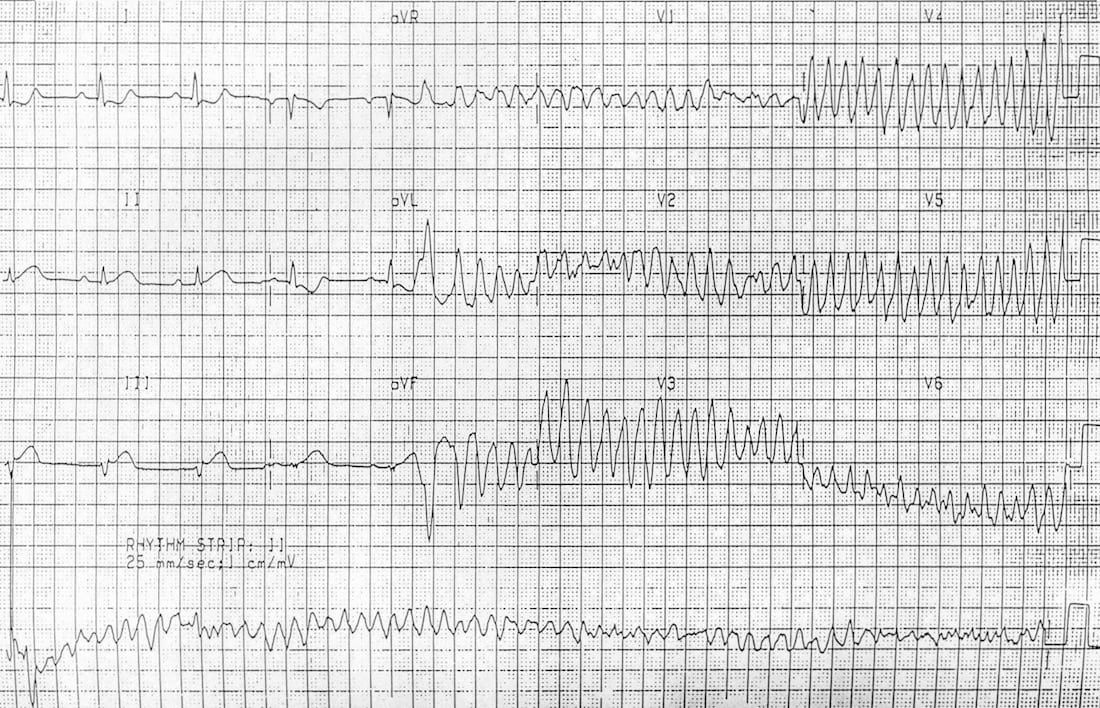 fine ventricular fibrillation vs coarse ventricular fibrillation