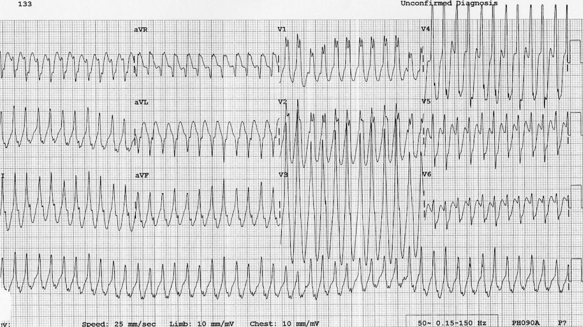 Pre Excitation Syndromes Litfl Ecg Library Diagnosis