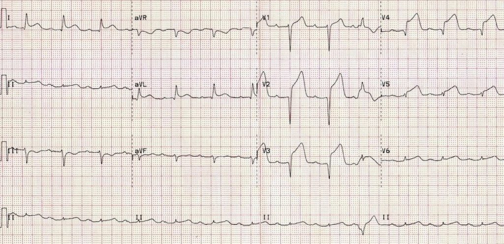 ECG Anterior STEMI Evolving 2