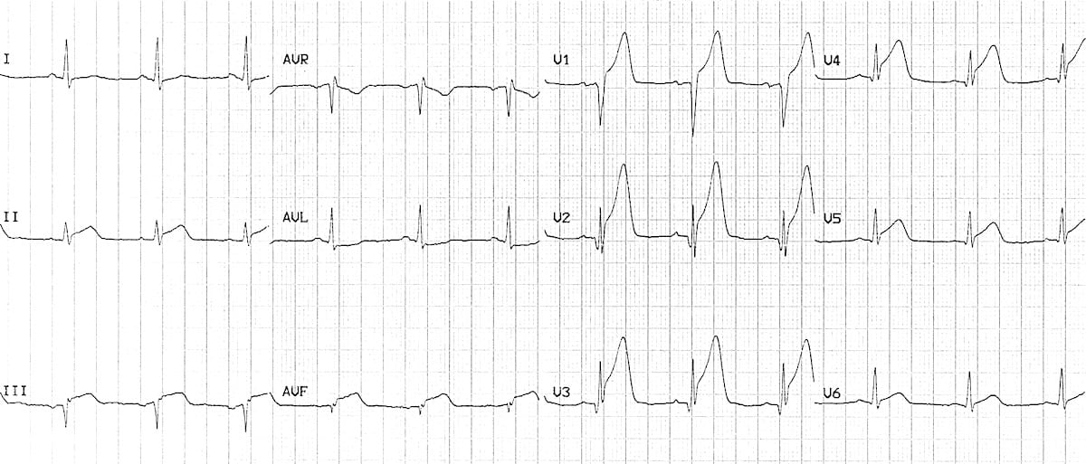 Anterior Myocardial Infarction Ecg