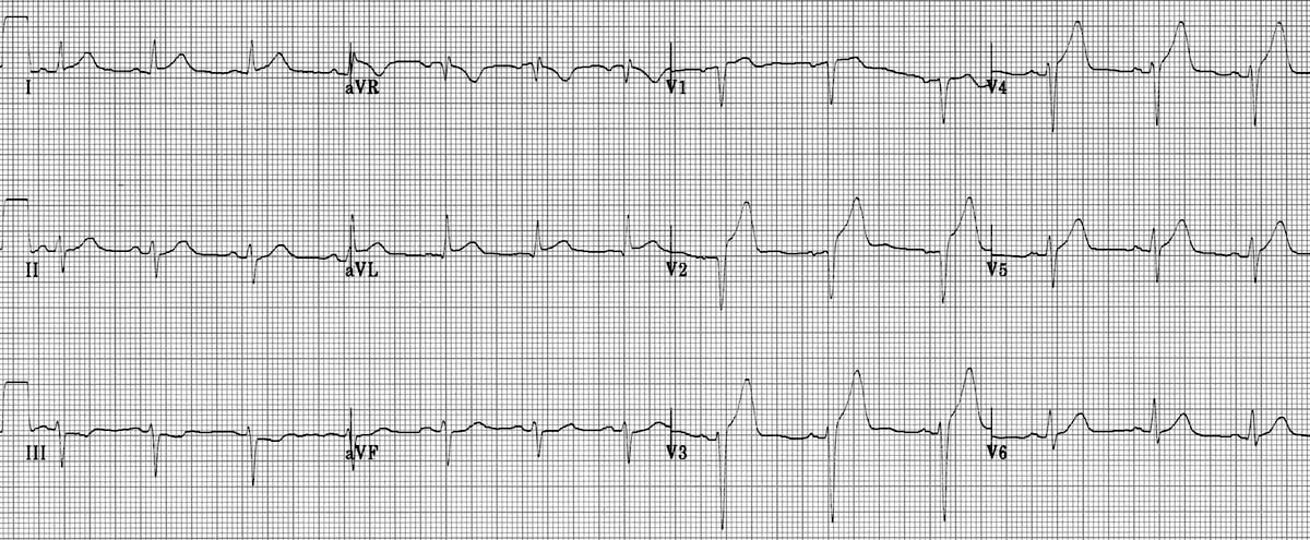 normal ecg vs heart attack ecg