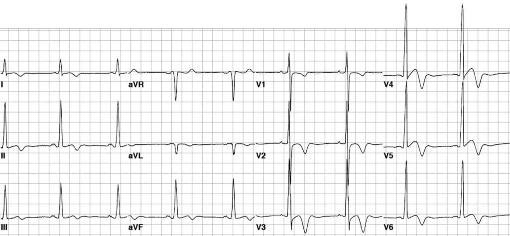 ECG Apical HCM HOCM