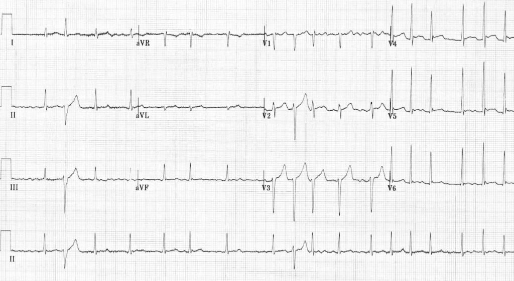 ECG Ashman aberrancy 4