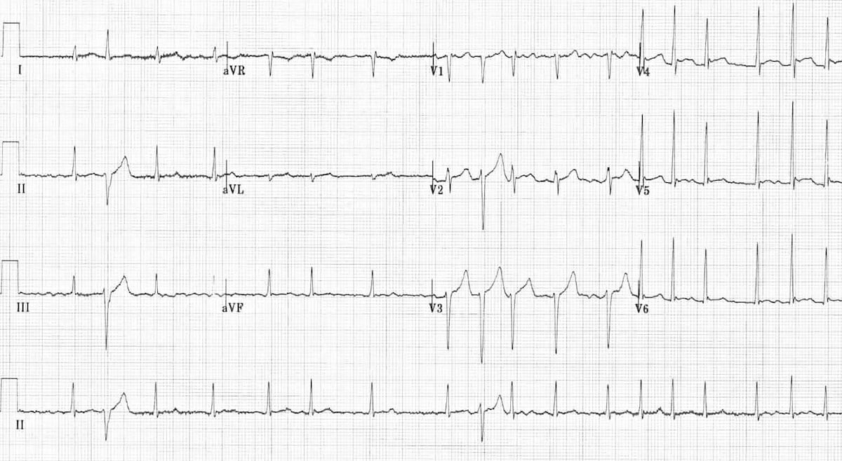 Atrial Fibrillation Litfl Ecg Library Diagnosis