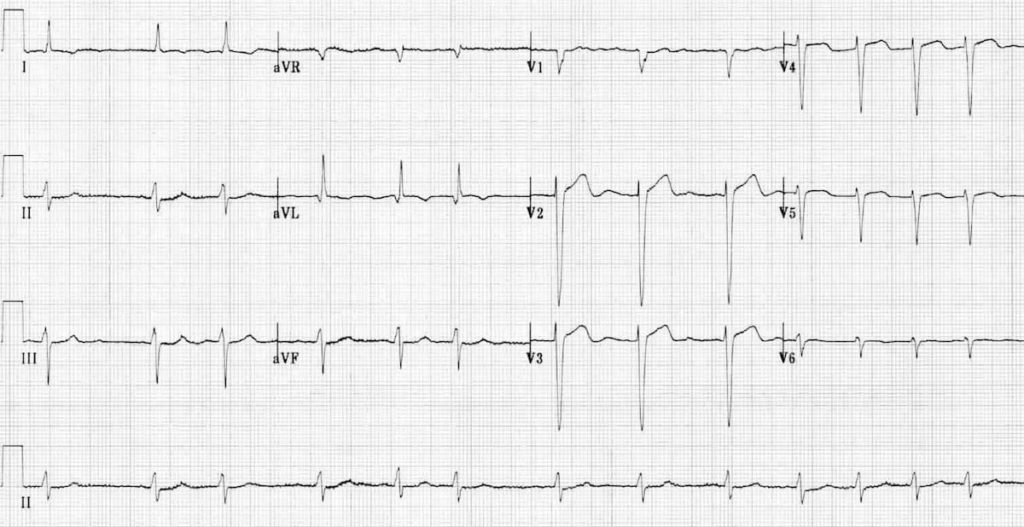 Atrial Fibrillation Litfl Ecg Library Diagnosis