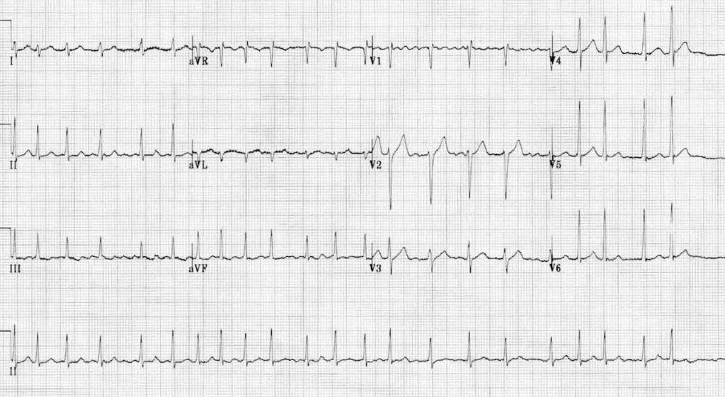 Understanding the EKG Signal - Atrial Fibrillation: Resources for  PatientsAtrial Fibrillation: Resources for Patients