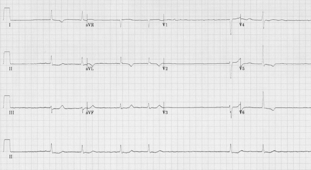 ECG Atrial Fibrillation Slow ventricular response