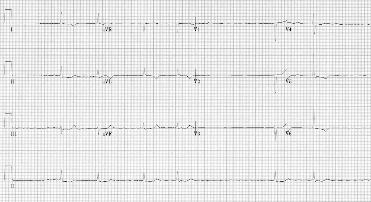 Atrial Fibrillation • LITFL • ECG Library Diagnosis